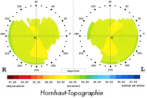 Hornhaut Topographie